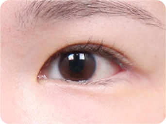 Dual Epicanthoplasty STEP 04