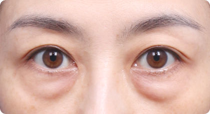 4050 눈밑유형