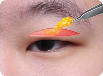 切开 STEP 02