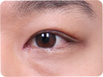 非切开 STEP 04