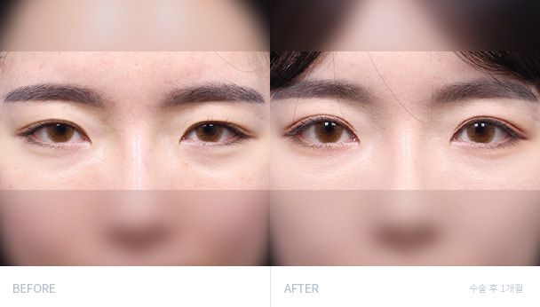 Блефаропластика 전후 비교 1