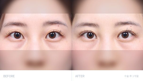 Блефаропластика 전후 비교 2