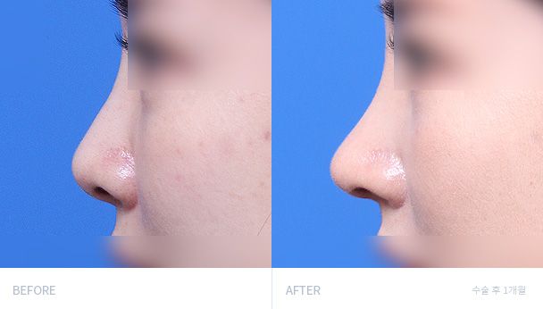 Ринопластика 전후 비교 1