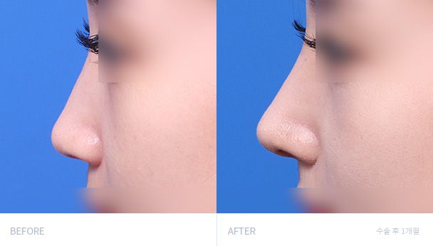 Ринопластика 전후 비교 2