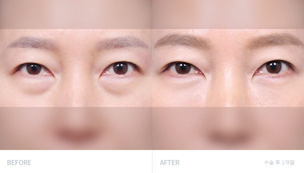 Репозиция жира нижнего века 전후 비교 1
