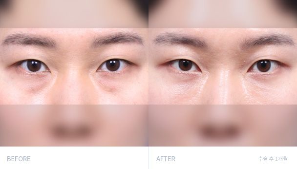 Репозиция жира нижнего века 전후 비교 2