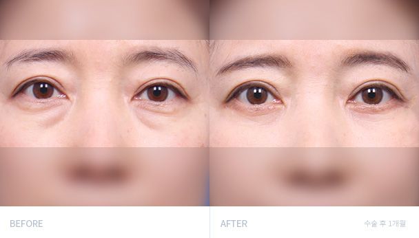 Нижняя блефаропластика 전후 비교 1