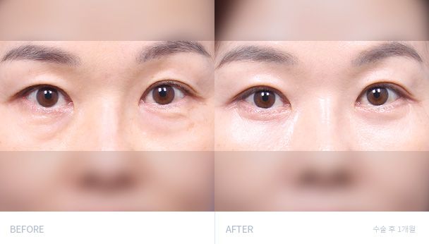 Нижняя блефаропластика 전후 비교 2