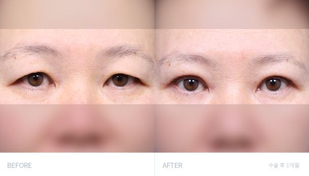 Верхняя блефаропластика 전후 비교 1