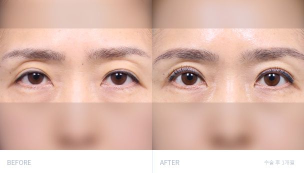 Верхняя блефаропластика 전후 비교 2